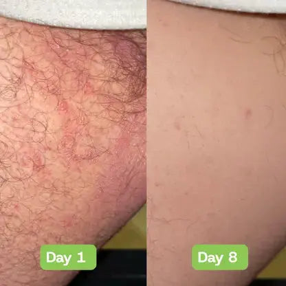 Veloria AntiFungal Relief - Veloria