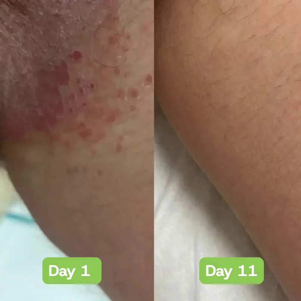 Veloria AntiFungal Relief - Veloria