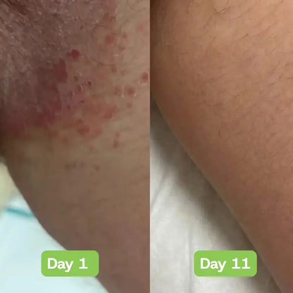 Veloria AntiFungal Relief - Veloria