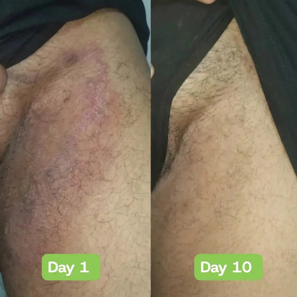Veloria AntiFungal Relief - Veloria