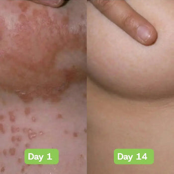 Veloria AntiFungal Relief - Veloria