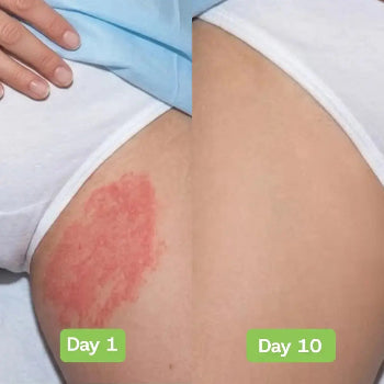 Veloria AntiFungal Relief - Veloria